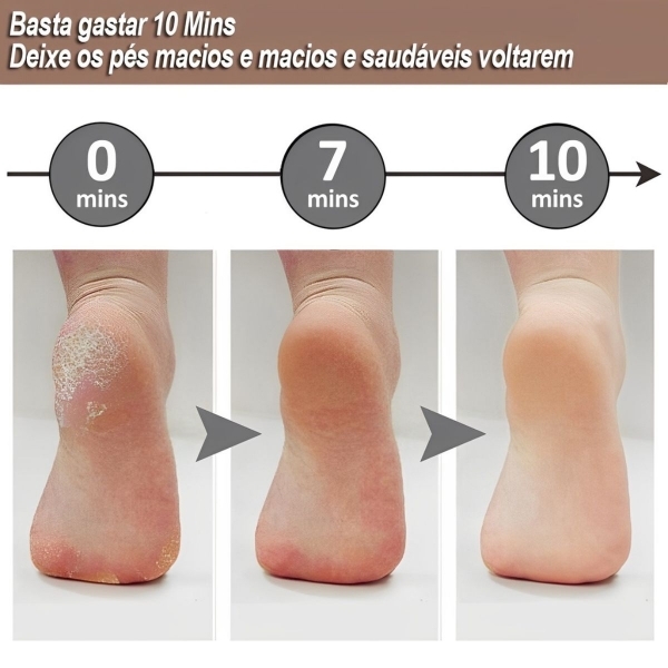 Soft Feet - Removedor de Calos e Rachaduras dos Pés